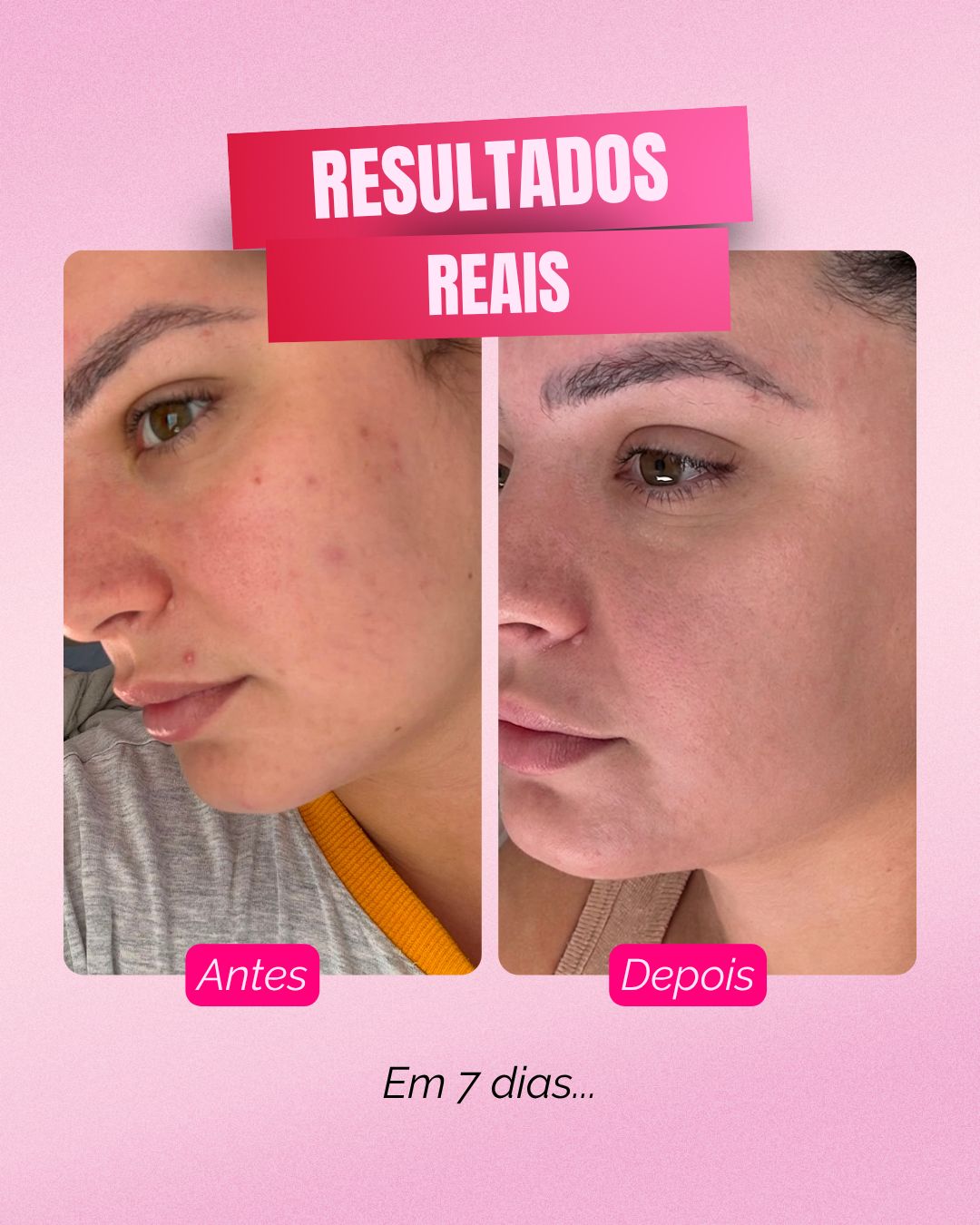 Resultado sooē — 5 dias