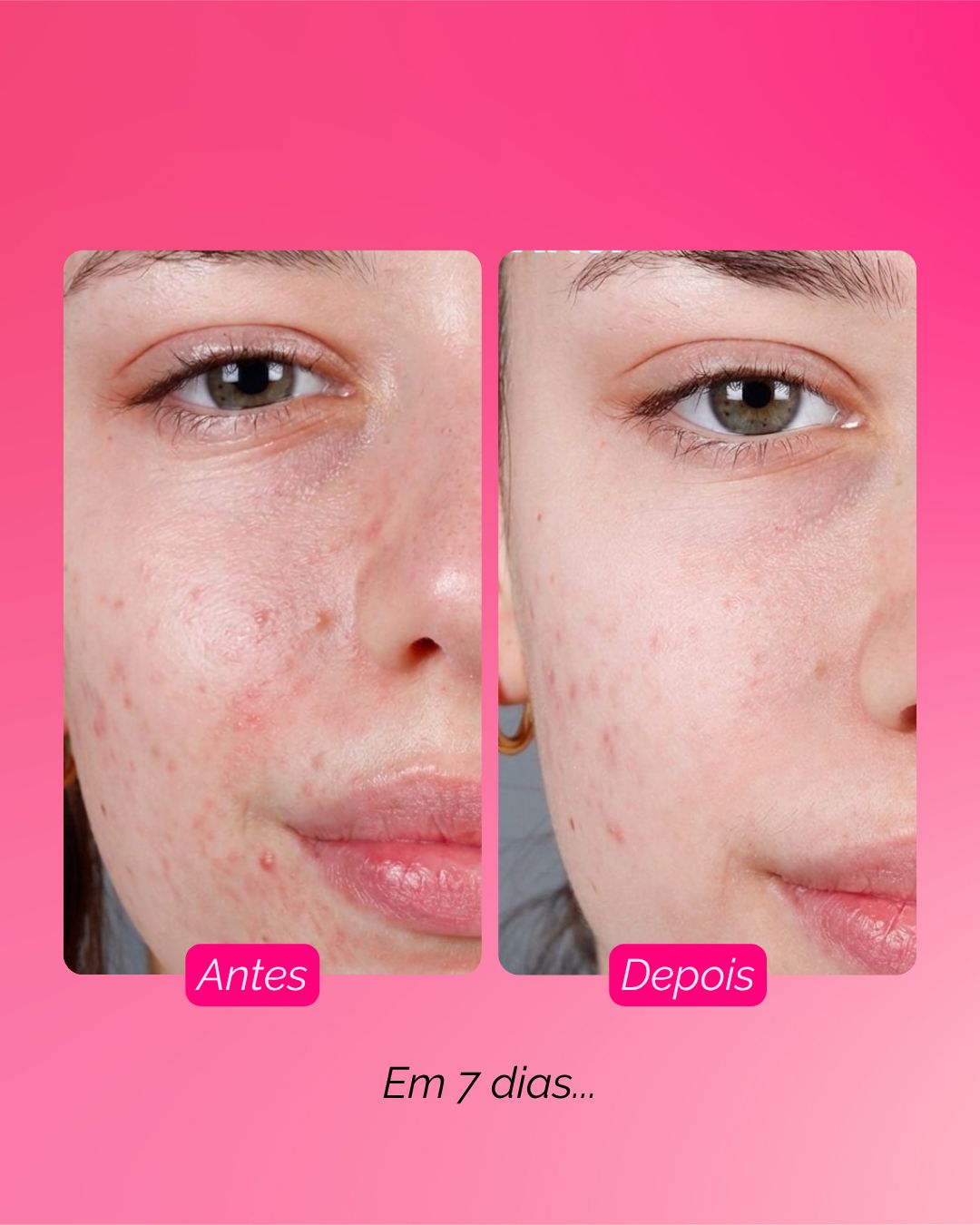 Resultado sooē — 7 dias